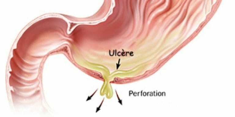 Comment soigner un ulcère à l’estomac avec des remèdes naturels ?